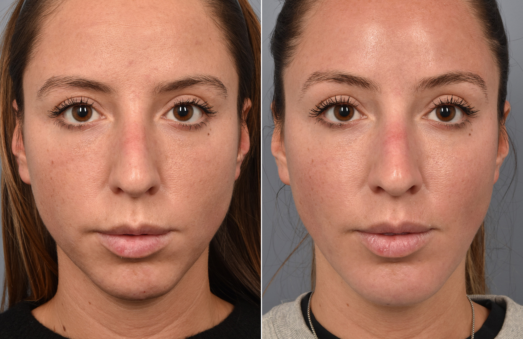 Liposuction Before & After Gallery - Patient 143324 - Image 3