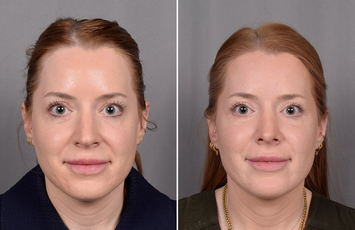 Rhinoplasty Before & After Gallery - Patient 322287 - Image 4