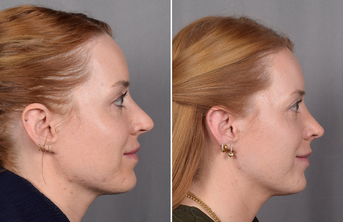 Rhinoplasty Before & After Gallery - Patient 322287 - Image 2