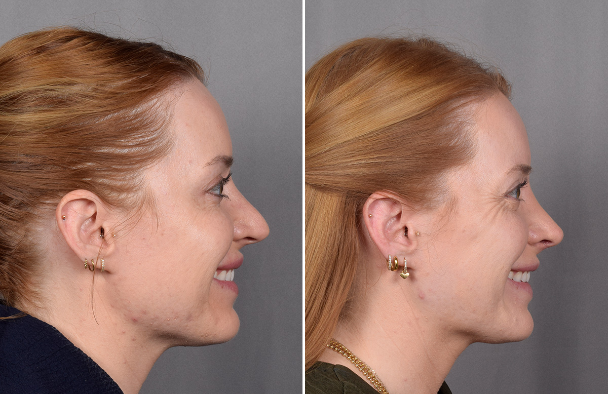 Rhinoplasty Before & After Gallery - Patient 322287 - Image 1