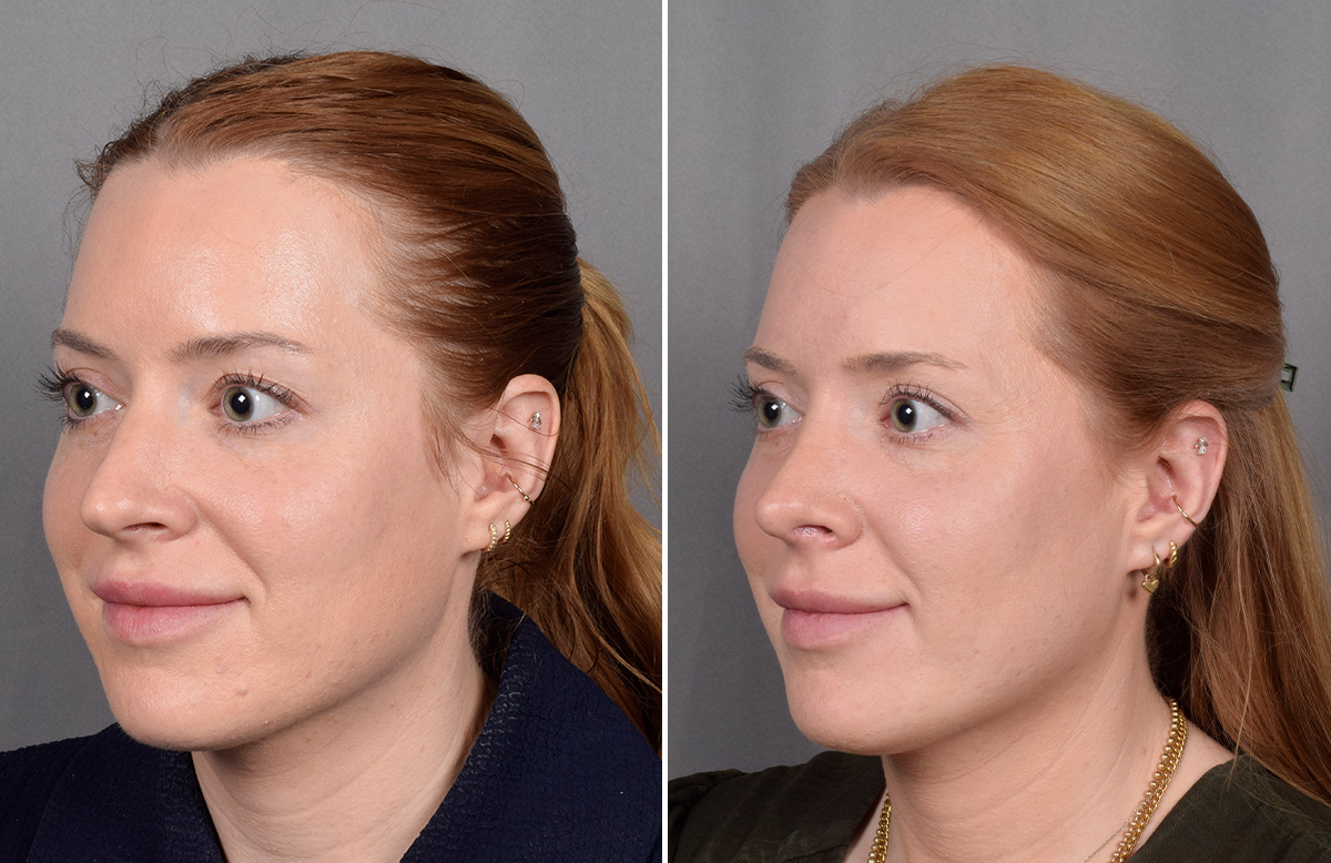 Rhinoplasty Before & After Gallery - Patient 322287 - Image 5