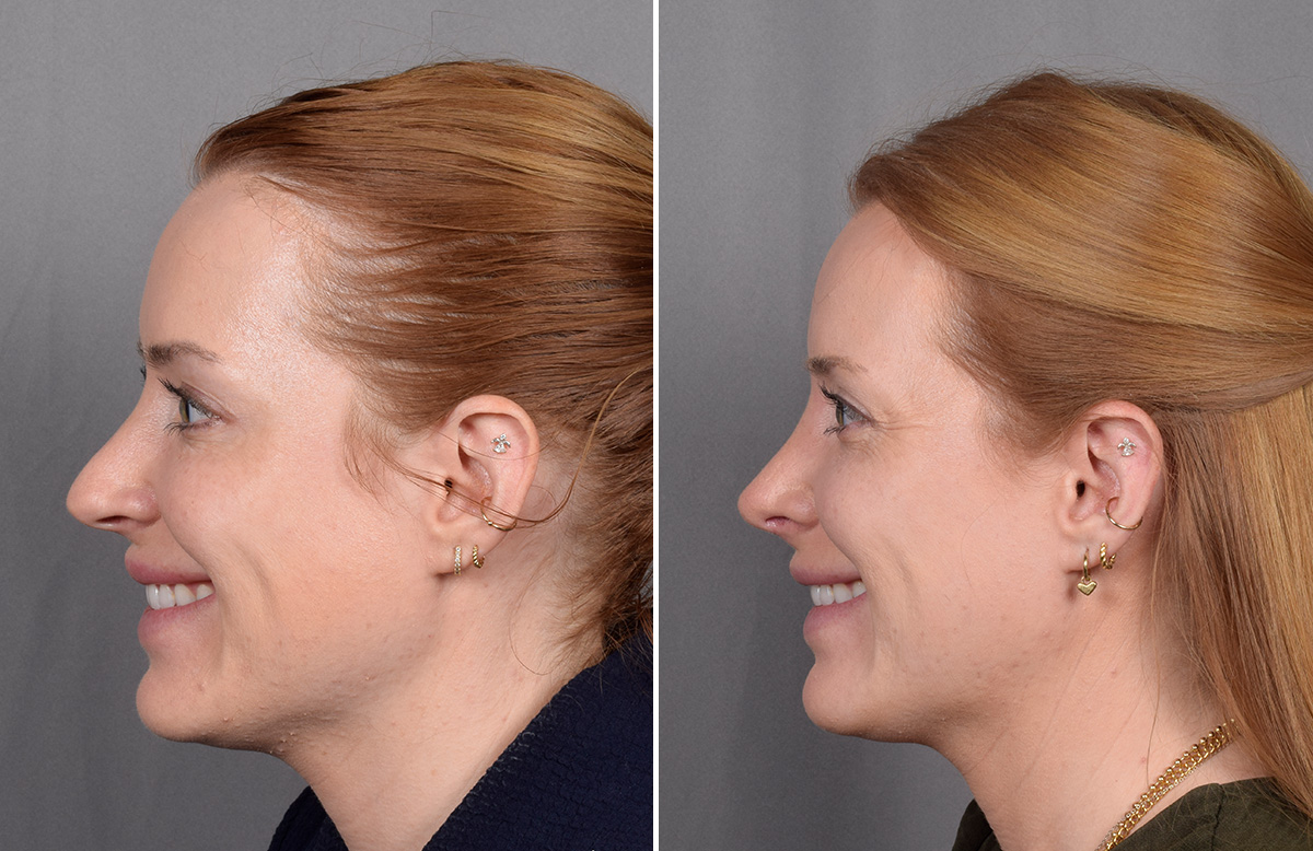 Rhinoplasty Before & After Gallery - Patient 322287 - Image 7