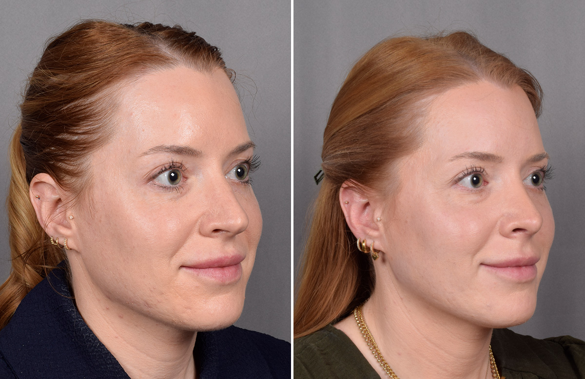 Rhinoplasty Before & After Gallery - Patient 322287 - Image 3