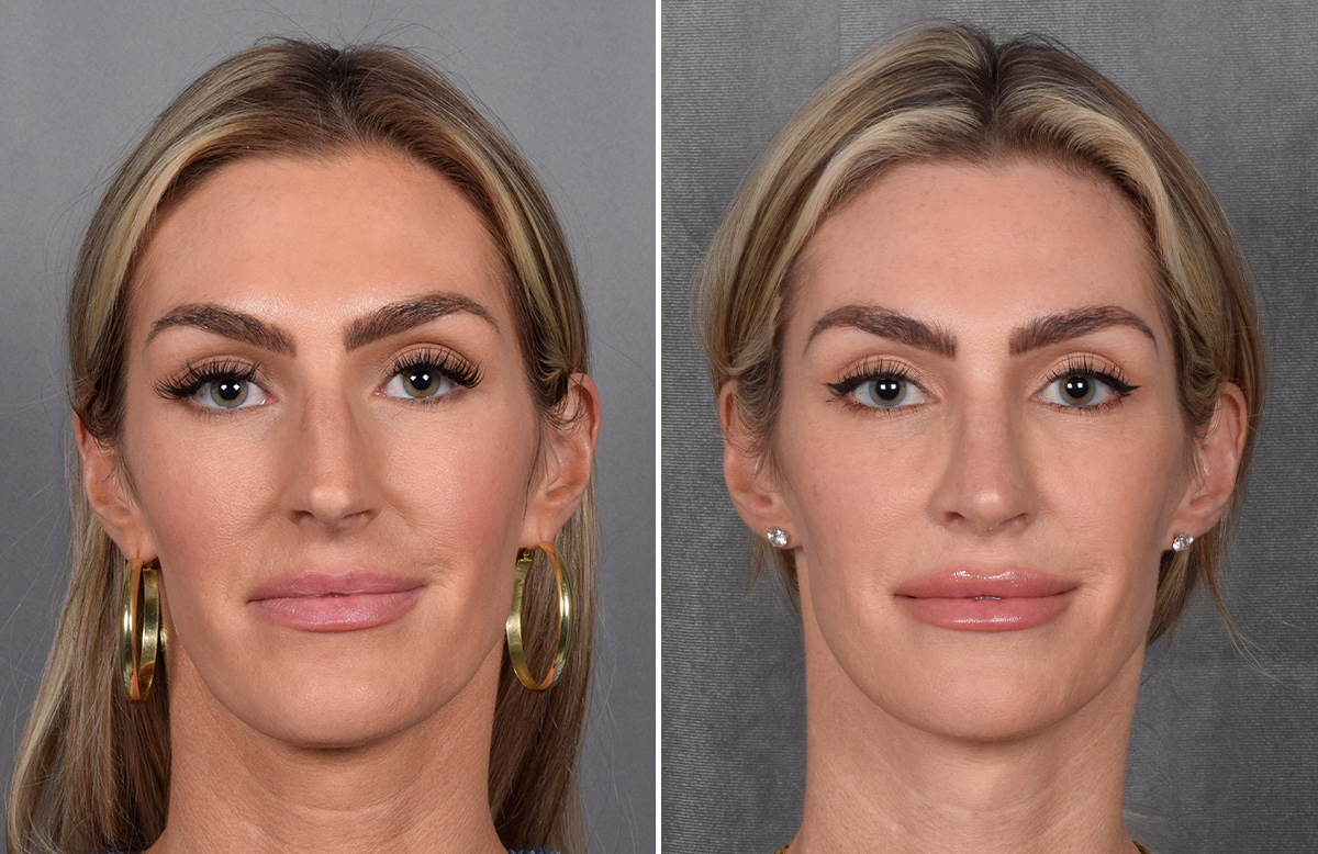 Rhinoplasty Before & After Gallery - Patient 111075 - Image 4