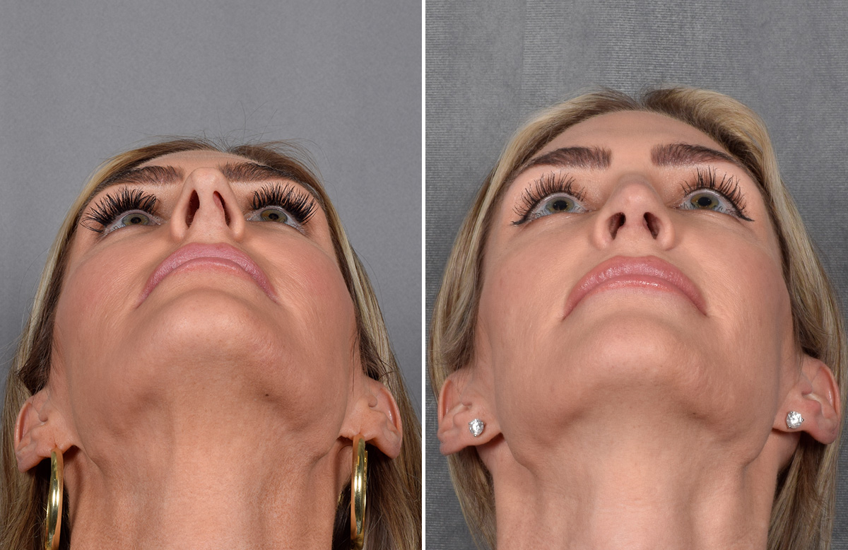 Rhinoplasty Before & After Gallery - Patient 111075 - Image 5
