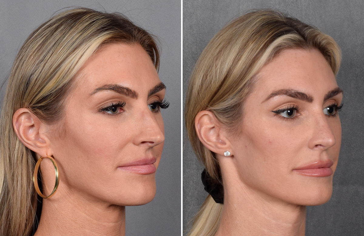 Rhinoplasty Before & After Gallery - Patient 111075 - Image 3