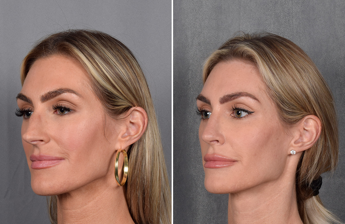 Rhinoplasty Before & After Gallery - Patient 111075 - Image 6