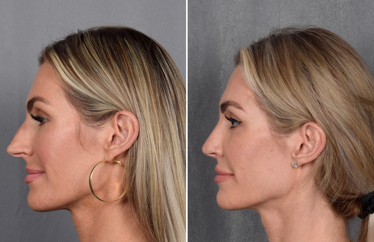 Rhinoplasty Before & After Gallery - Patient 111075 - Image 7