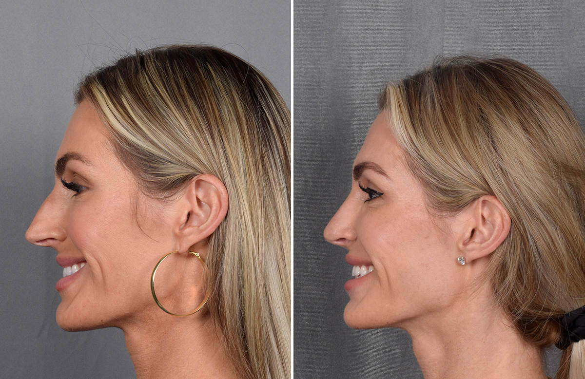 Rhinoplasty Before & After Gallery - Patient 111075 - Image 8