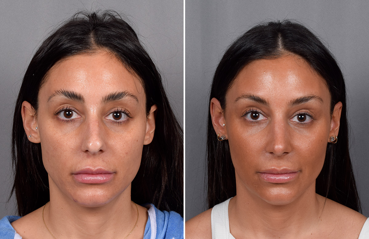 Rhinoplasty Before & After Gallery - Patient 240283 - Image 4