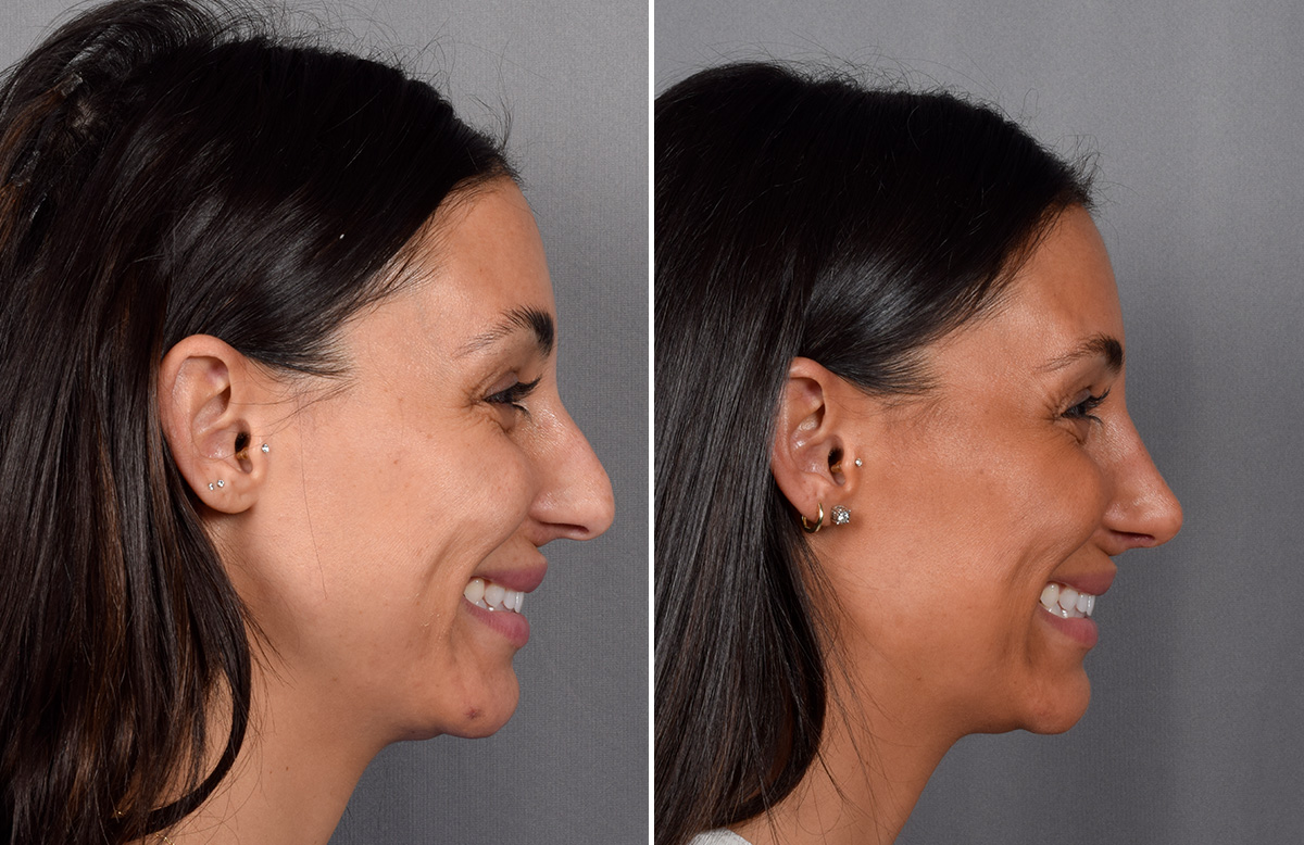 Rhinoplasty Before & After Gallery - Patient 240283 - Image 1
