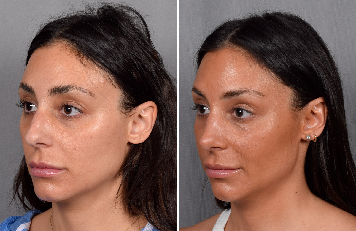 Rhinoplasty Before & After Gallery - Patient 240283 - Image 5