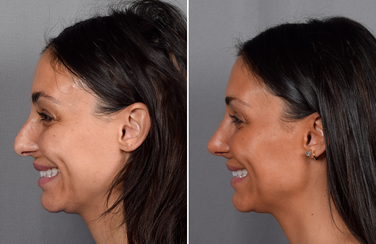 Rhinoplasty Before & After Gallery - Patient 240283 - Image 7