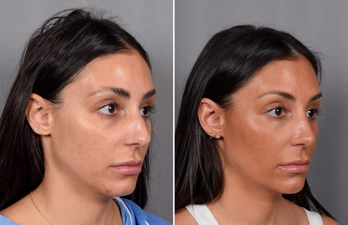 Rhinoplasty Before & After Gallery - Patient 240283 - Image 3