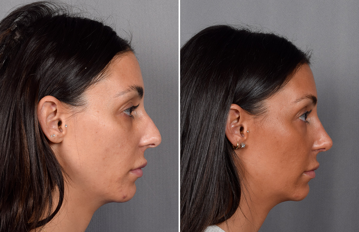 Rhinoplasty Before & After Gallery - Patient 240283 - Image 2