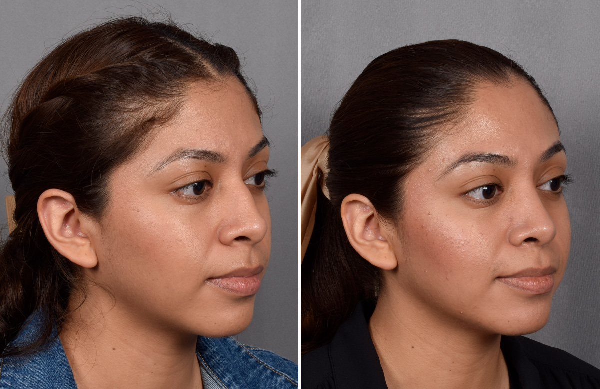 Rhinoplasty Before & After Gallery - Patient 315439 - Image 3