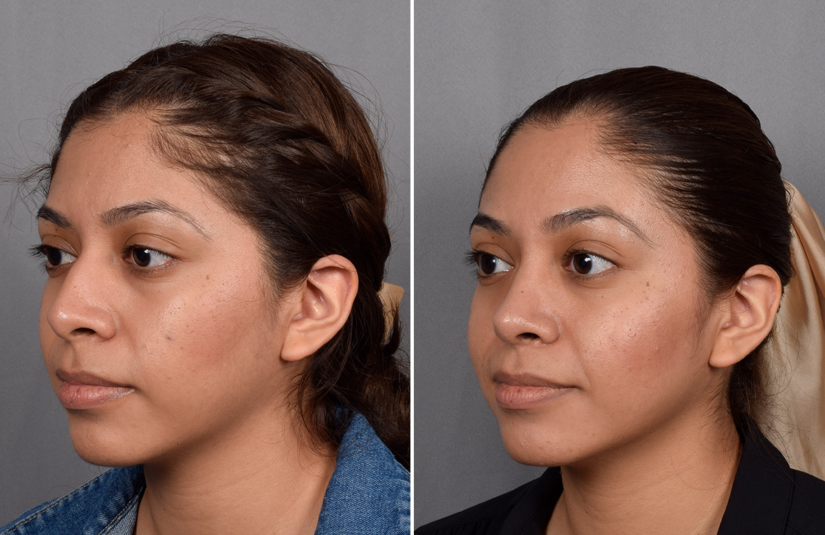 Rhinoplasty Before & After Gallery - Patient 315439 - Image 5