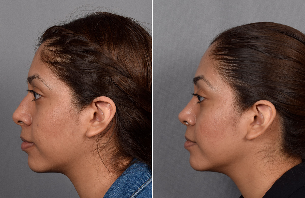 Rhinoplasty Before & After Gallery - Patient 315439 - Image 6