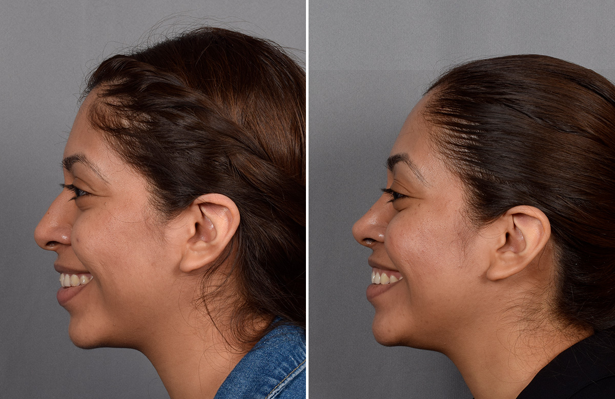 Rhinoplasty Before & After Gallery - Patient 315439 - Image 7