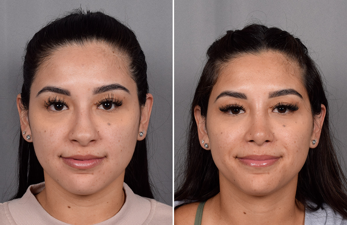 Rhinoplasty Before & After Gallery - Patient 230343 - Image 4