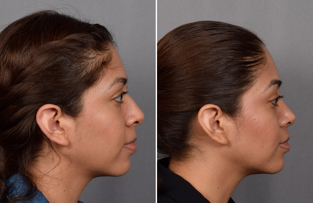 Rhinoplasty Before & After Gallery - Patient 315439 - Image 2