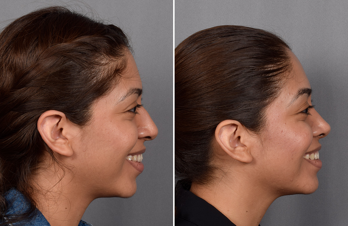 Rhinoplasty Before & After Gallery - Patient 315439 - Image 1