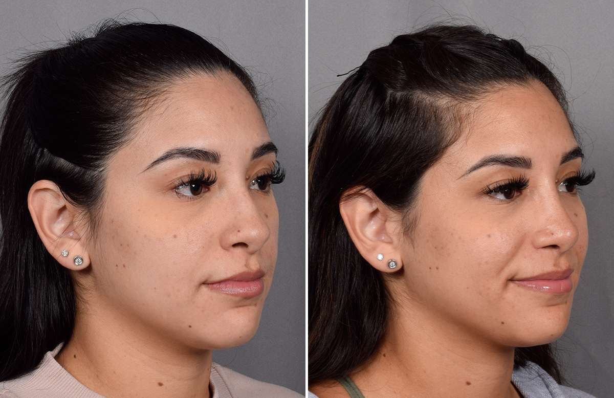 Rhinoplasty Before & After Gallery - Patient 230343 - Image 3