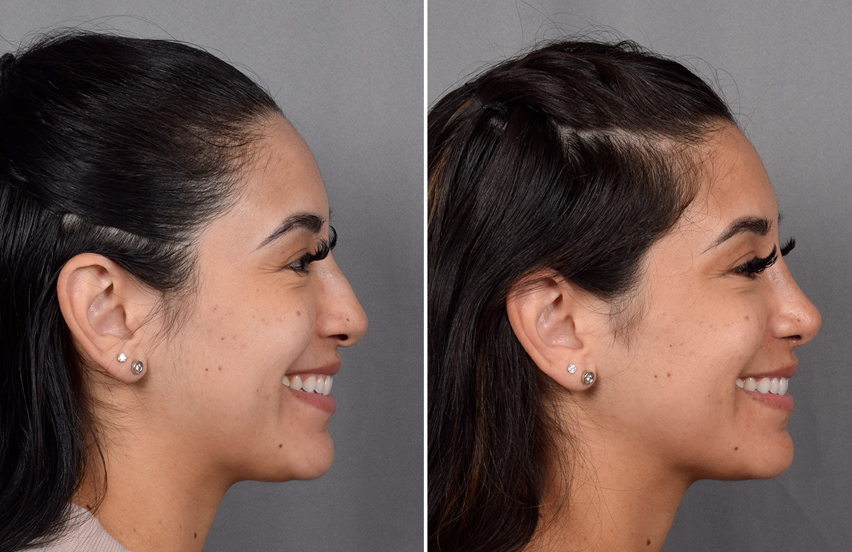 Rhinoplasty Before & After Gallery - Patient 230343 - Image 1