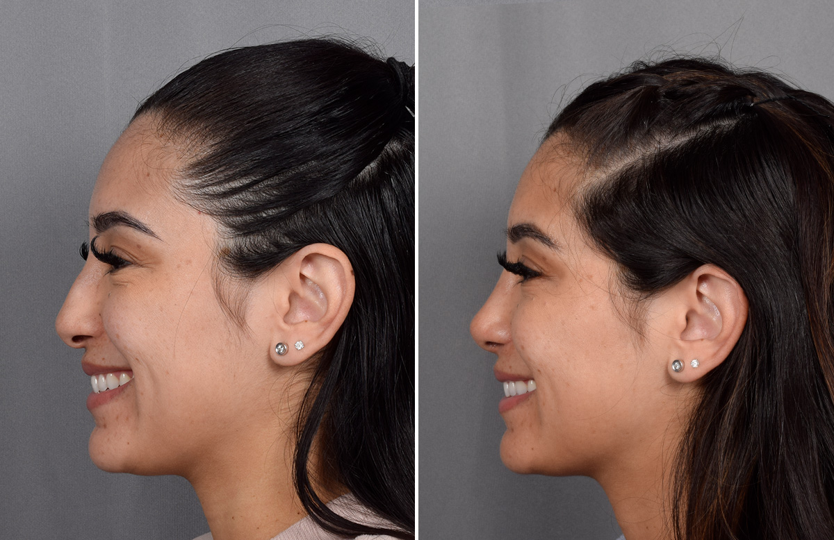 Rhinoplasty Before & After Gallery - Patient 230343 - Image 7