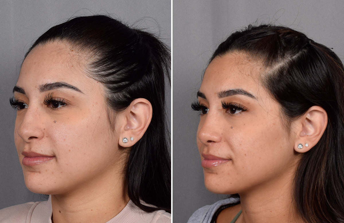 Rhinoplasty Before & After Gallery - Patient 230343 - Image 5