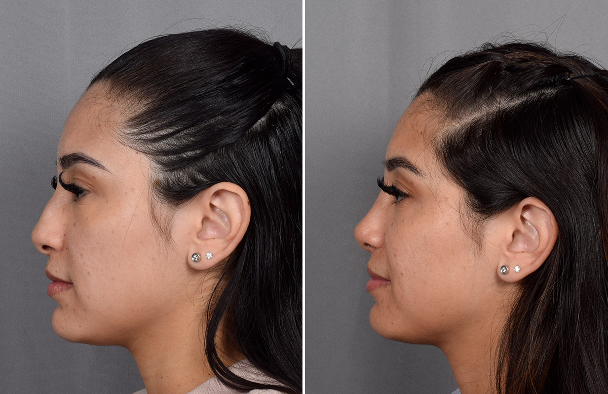 Rhinoplasty Before & After Gallery - Patient 230343 - Image 6