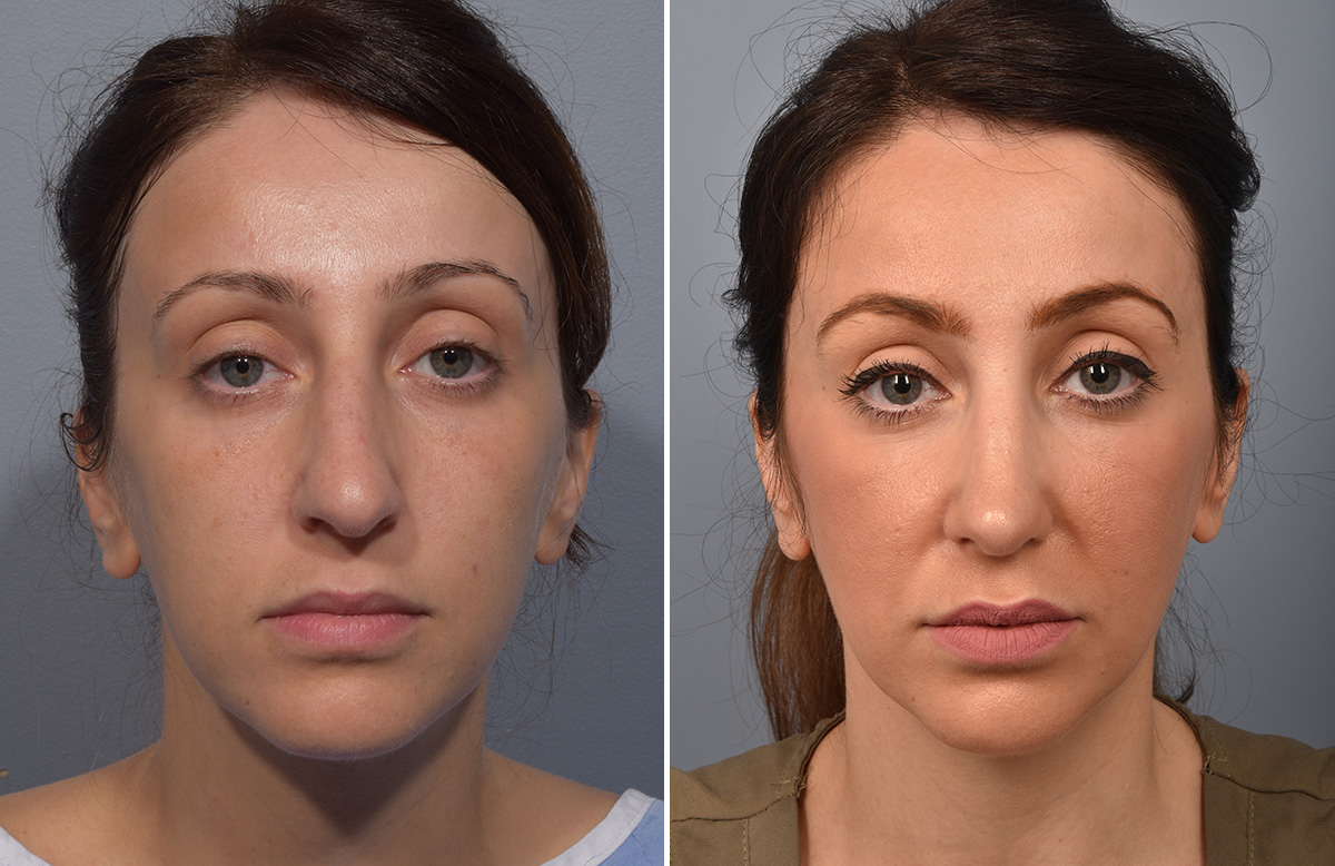 Rhinoplasty Before & After Gallery - Patient 110870 - Image 4