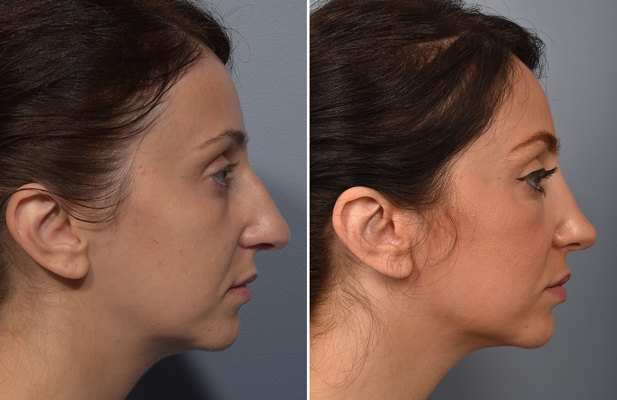 Rhinoplasty Before & After Gallery - Patient 110870 - Image 2