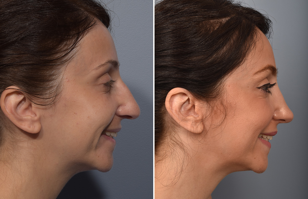 Rhinoplasty Before & After Gallery - Patient 110870 - Image 1