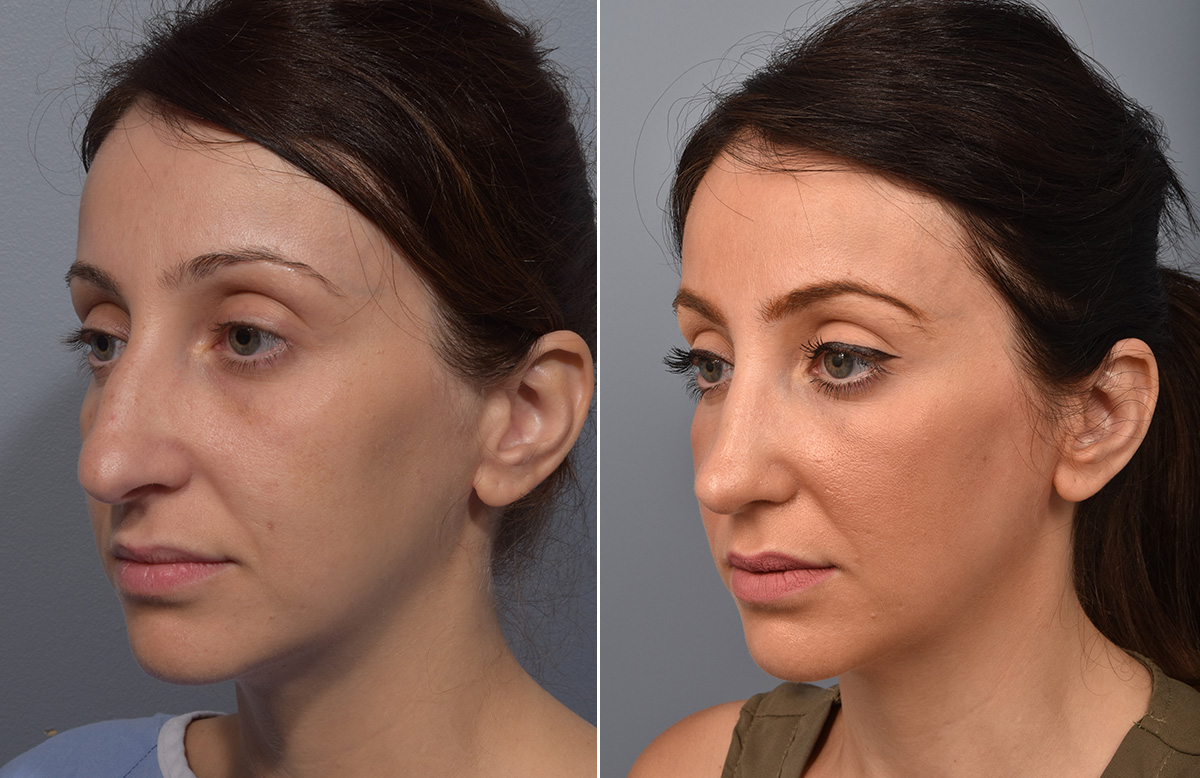 Rhinoplasty Before & After Gallery - Patient 110870 - Image 5