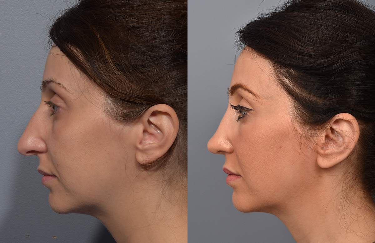 Rhinoplasty Before & After Gallery - Patient 110870 - Image 6