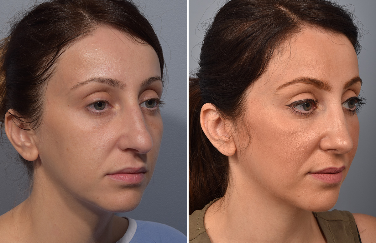 Rhinoplasty Before & After Gallery - Patient 110870 - Image 3