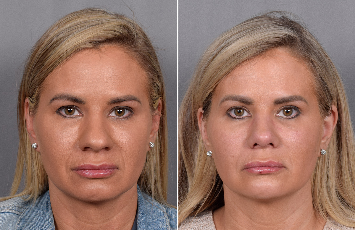 Rhinoplasty Before & After Gallery - Patient 236819 - Image 4
