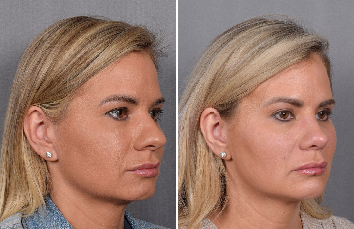 Rhinoplasty Before & After Gallery - Patient 236819 - Image 3