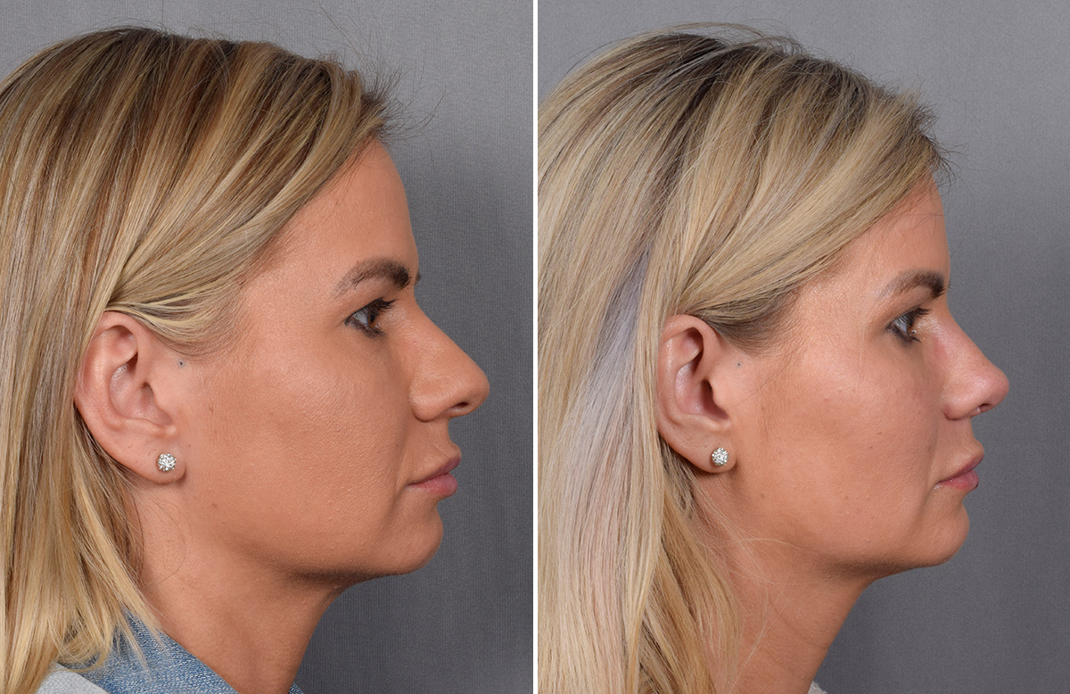 Rhinoplasty Before & After Gallery - Patient 236819 - Image 2