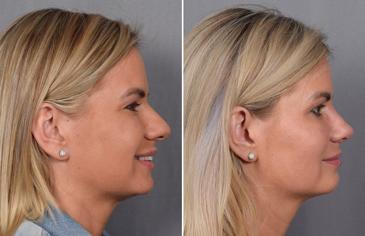 Rhinoplasty Before & After Gallery - Patient 236819 - Image 1