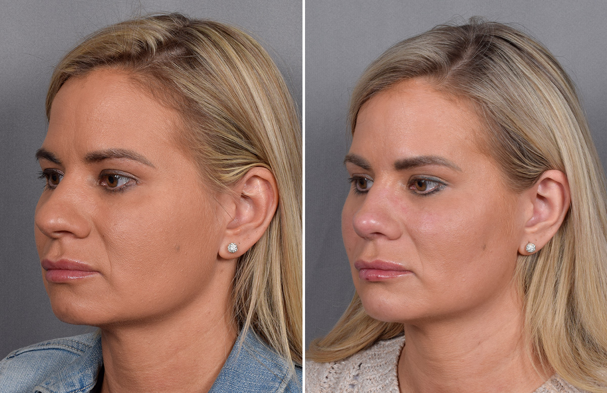 Rhinoplasty Before & After Gallery - Patient 236819 - Image 5