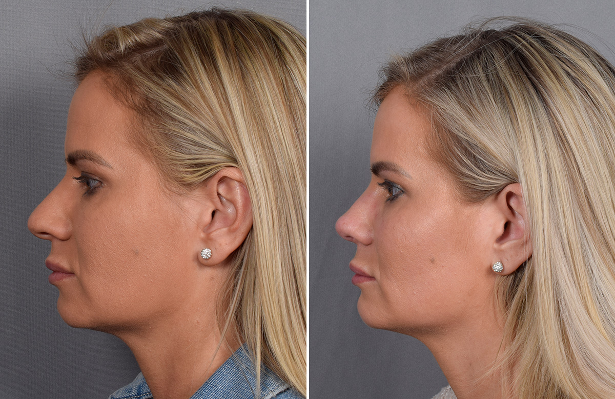 Rhinoplasty Before & After Gallery - Patient 236819 - Image 6