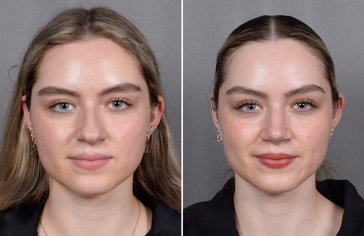 Rhinoplasty Before & After Gallery - Patient 423592 - Image 4