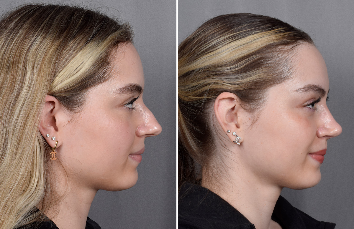 Rhinoplasty Before & After Gallery - Patient 423592 - Image 2