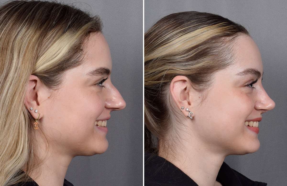 Rhinoplasty Before & After Gallery - Patient 423592 - Image 1