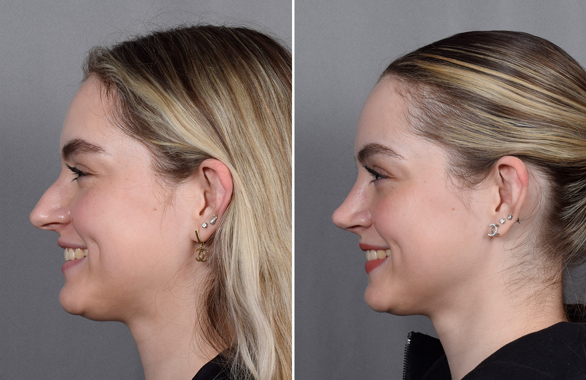 Rhinoplasty Before & After Gallery - Patient 423592 - Image 7