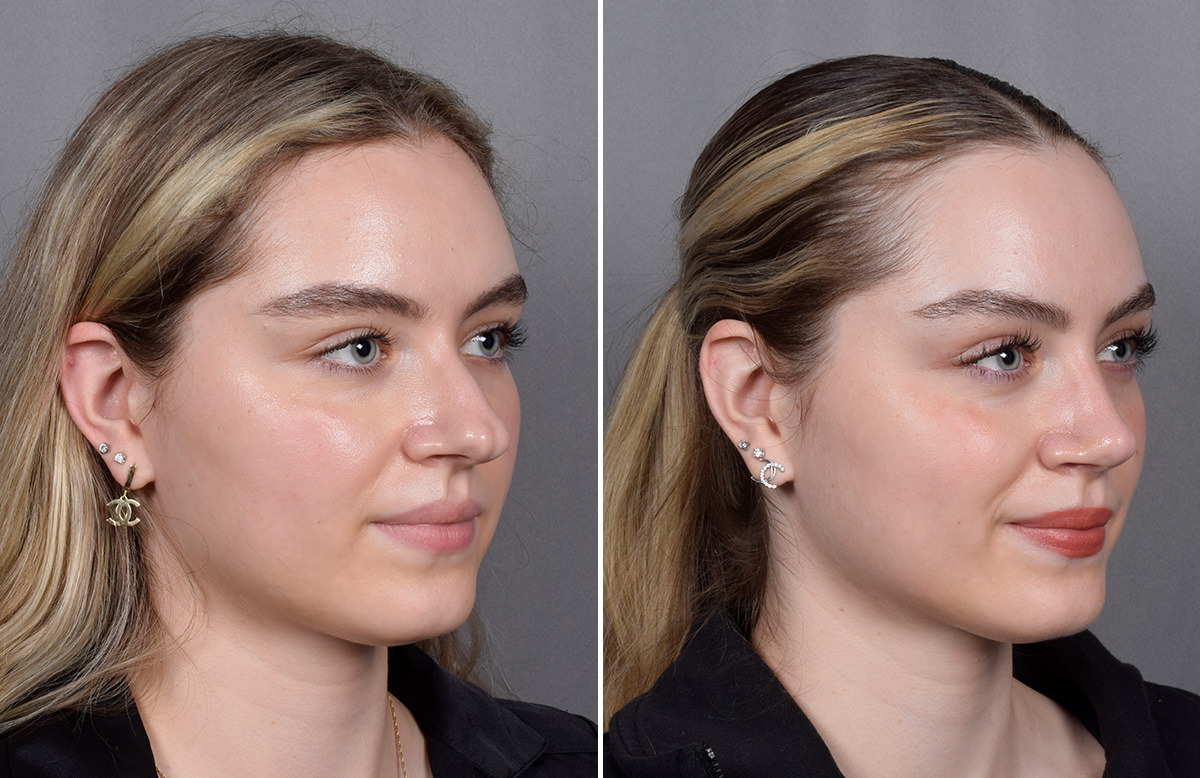 Rhinoplasty Before & After Gallery - Patient 423592 - Image 3