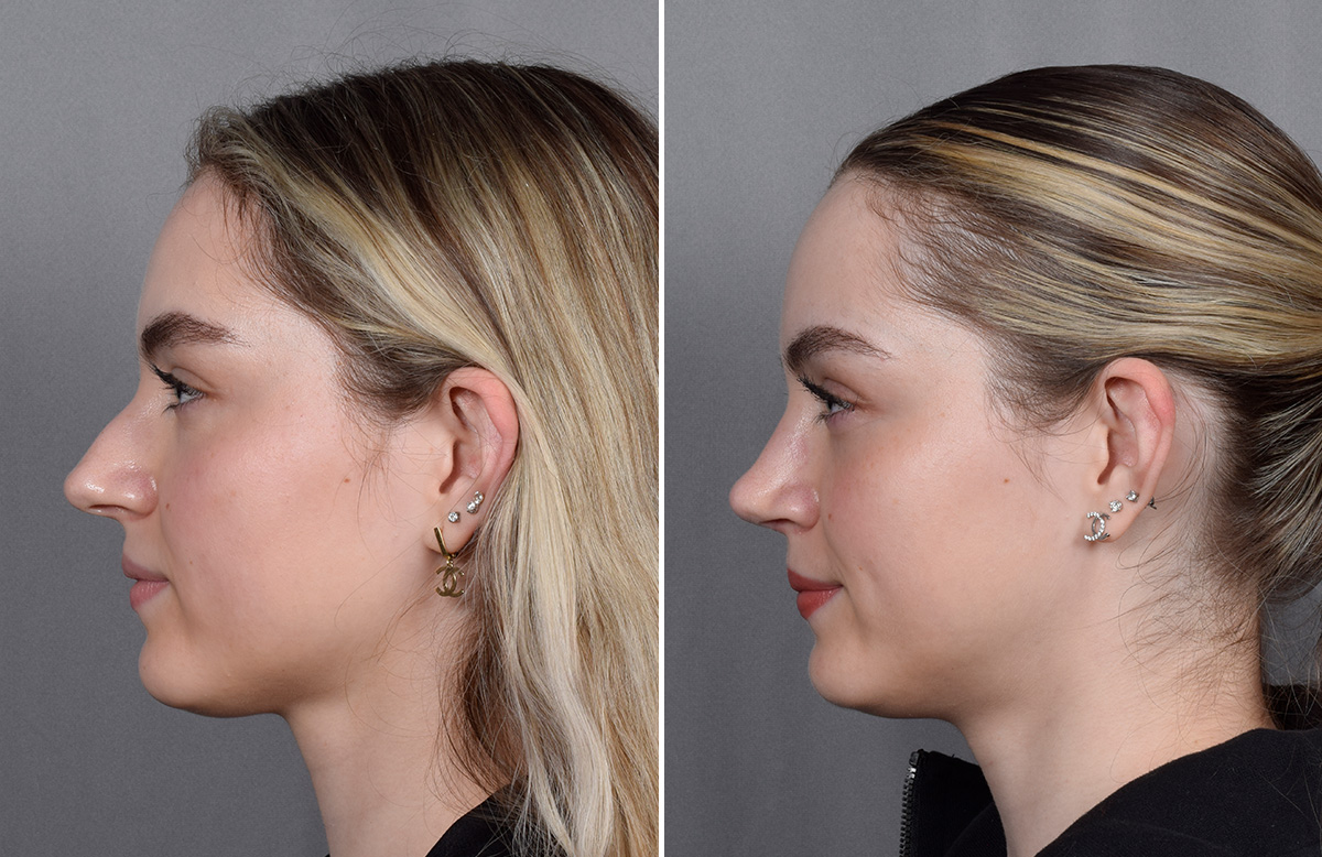 Rhinoplasty Before & After Gallery - Patient 423592 - Image 6