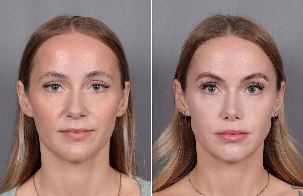 Rhinoplasty Before & After Gallery - Patient 641641 - Image 4